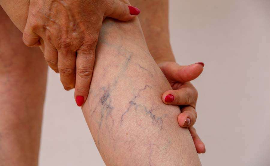 Spider Veins